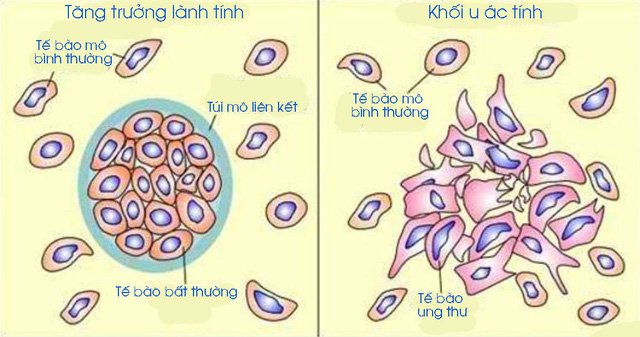 Sự hình thành các khối u ác tính hầu hết là do biến đổi gen của một số tế bào bình thường